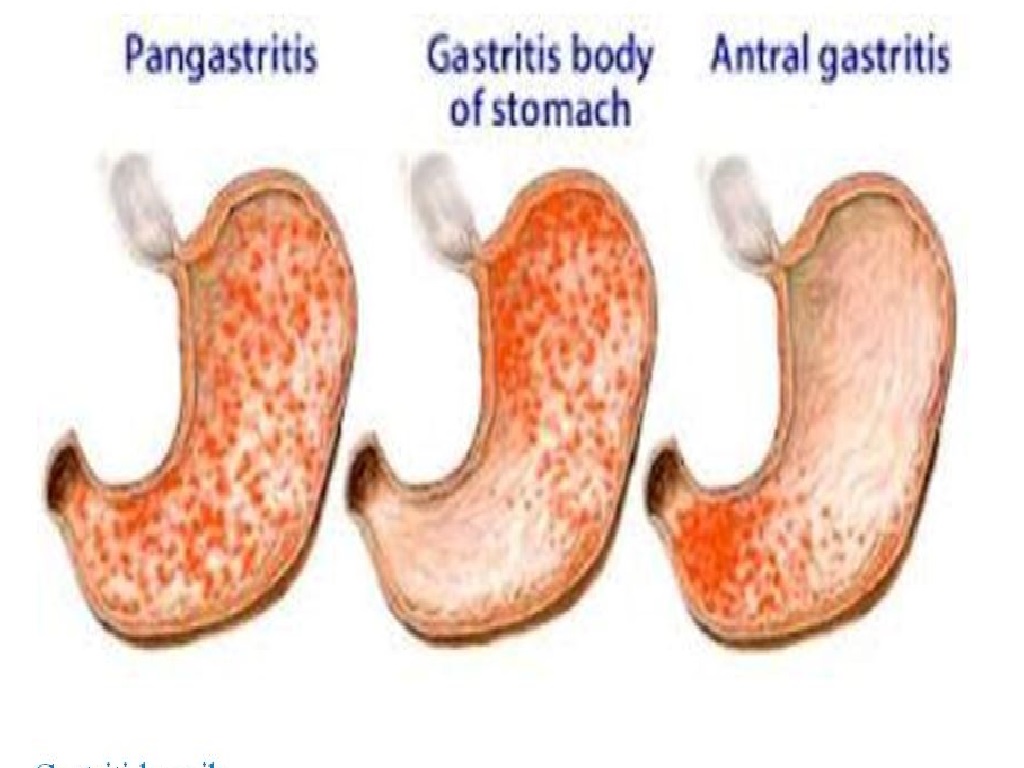Que es gastritis antral